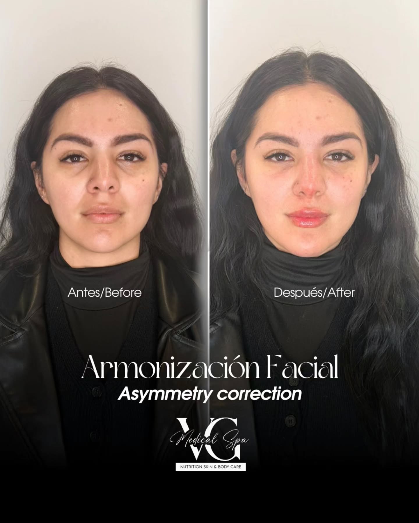 Before and after VG Medical Spa client result