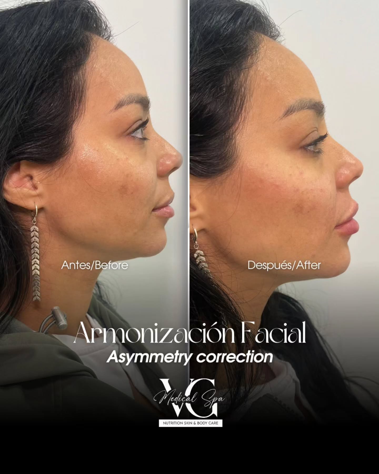 Before and after facial balancing result