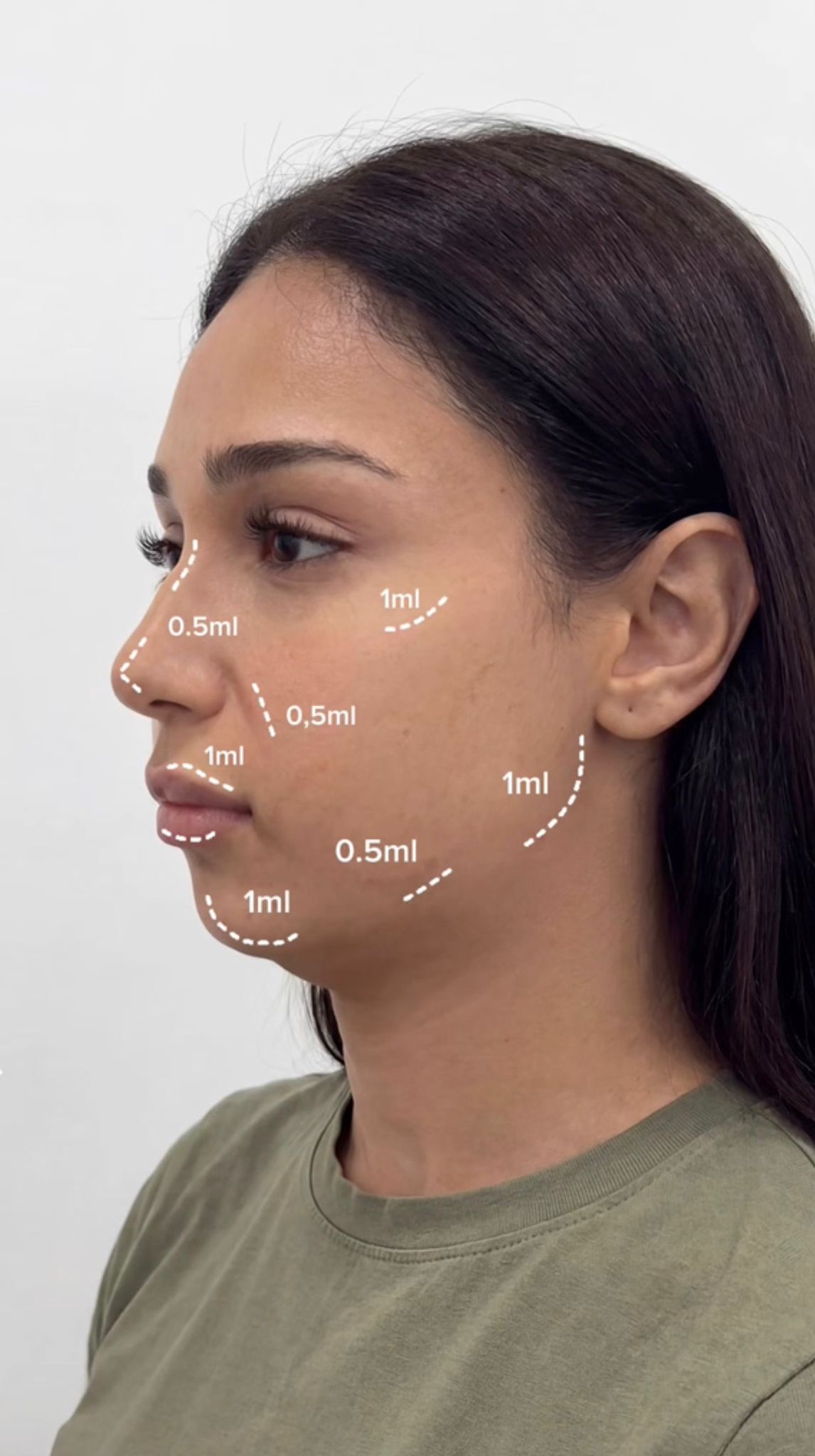 Memorial Botox and fillers result